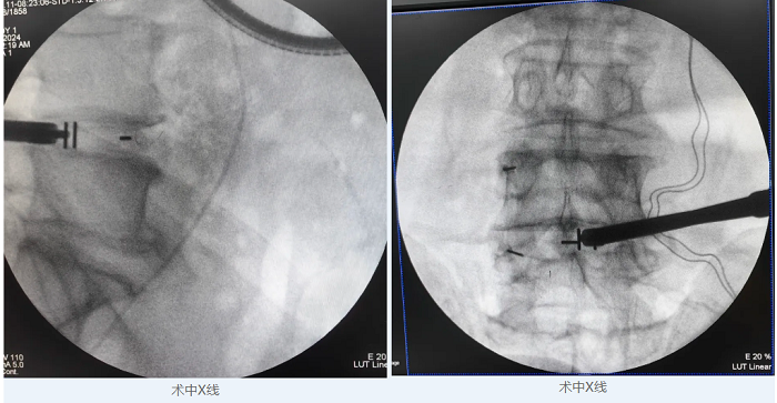 病例分享|重庆市巴南区人民医院开展第一台脊柱内镜腰椎椎间融合术