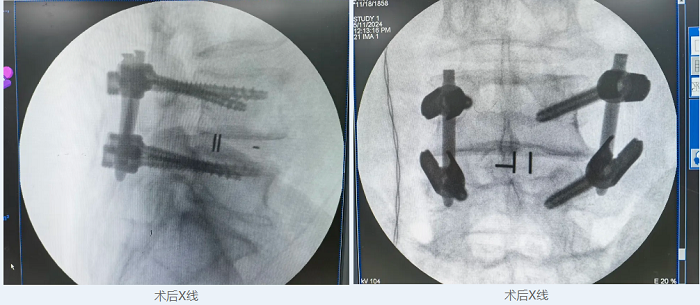 病例分享|重庆市巴南区人民医院开展第一台脊柱内镜腰椎椎间融合术