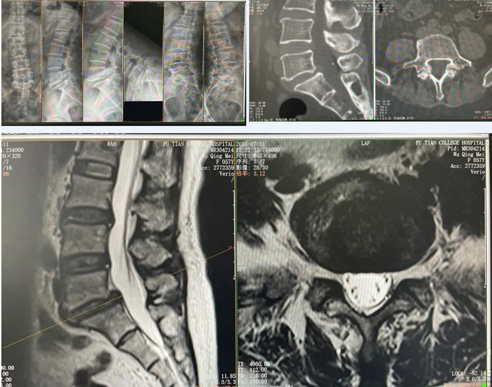 病例分享|大通道脊柱内镜+显微镜辅助减压融合（经皮椎弓根螺钉+可撑开融合器内固定术）一例