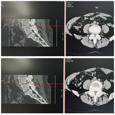 病例分享｜椎间孔镜下后侧入路腰椎体间融合术的病例
