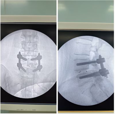 病例分享｜椎间孔镜下后侧入路腰椎体间融合术的病例